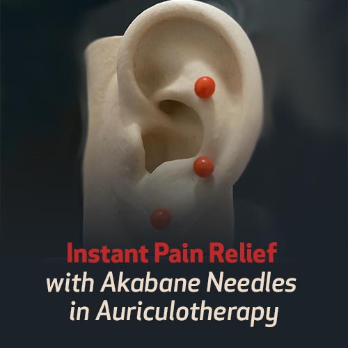 Instant Pain Relief with Akabane Needles in Auriculotherapy 